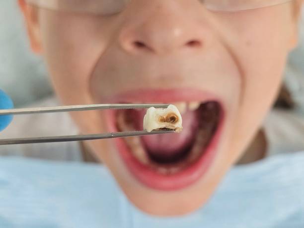 Best Emergency Tooth Extraction in Brooksi, DE